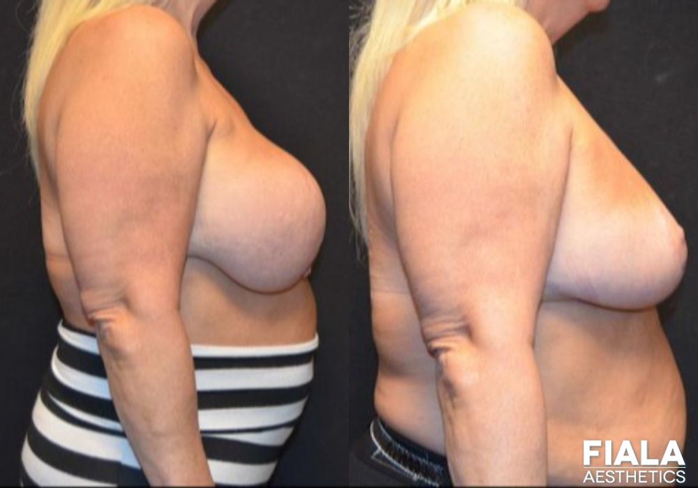 Breast Lift - Thumbnail 2