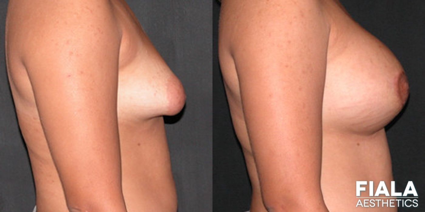 Before and after Breast Lift case 13752 - Angle 2