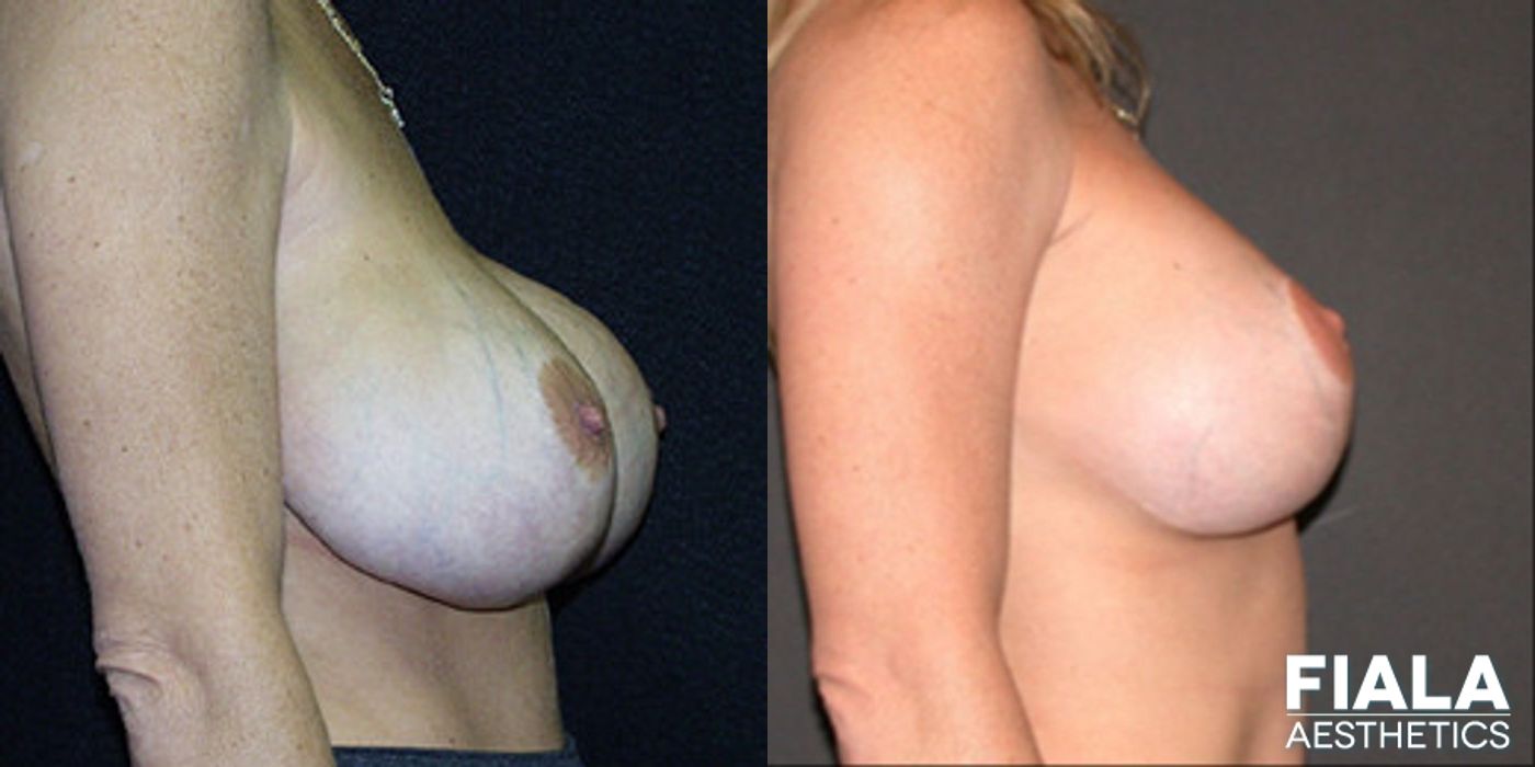 Before and after Breast Revision case 13747 - Angle 2