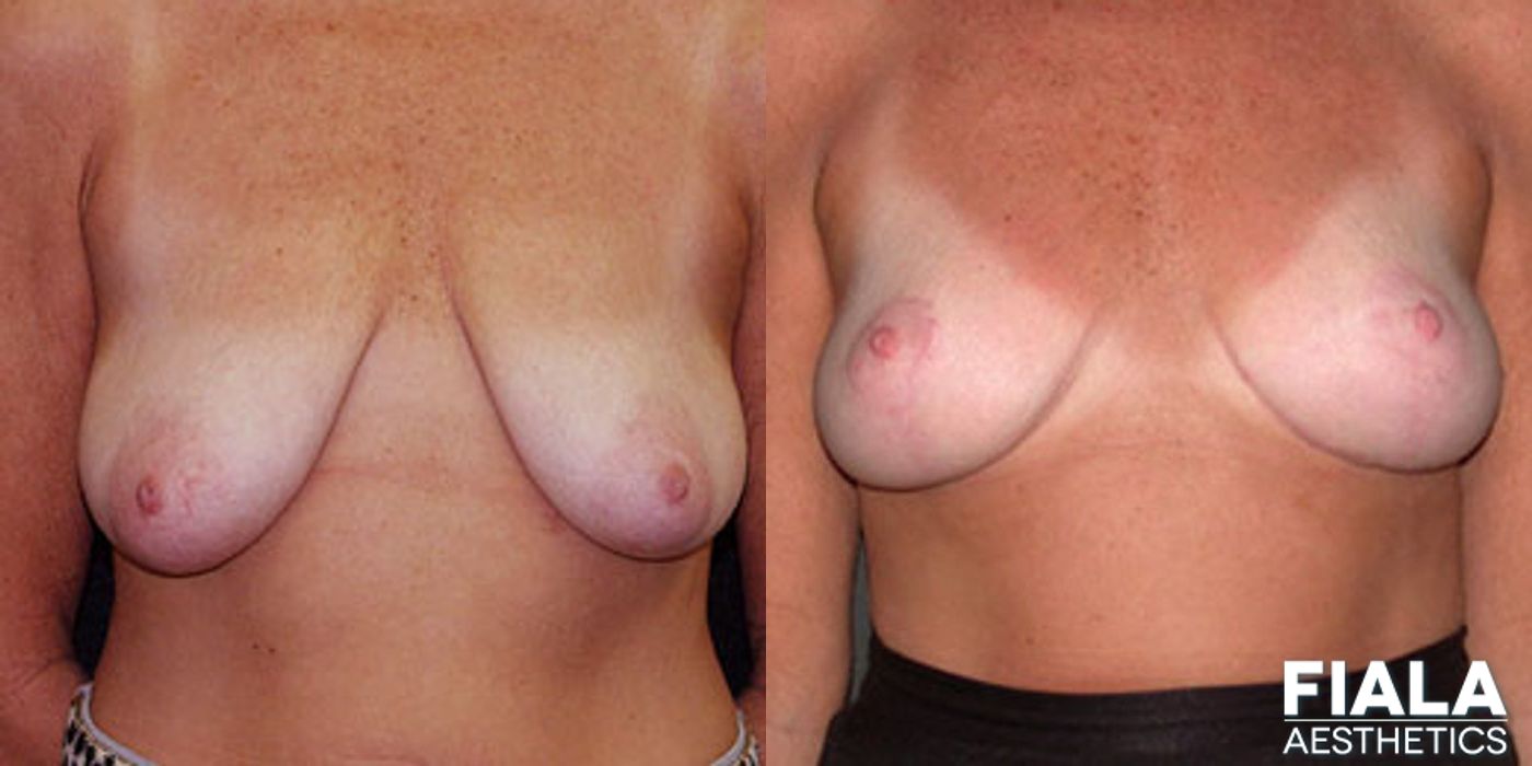 Breast Lift - Case 9179