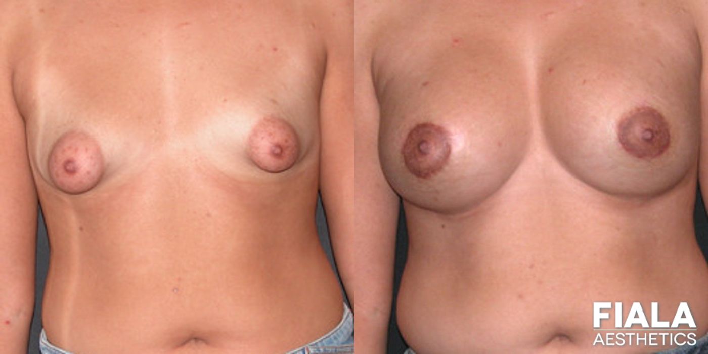 Before and after Breast Lift case 13752