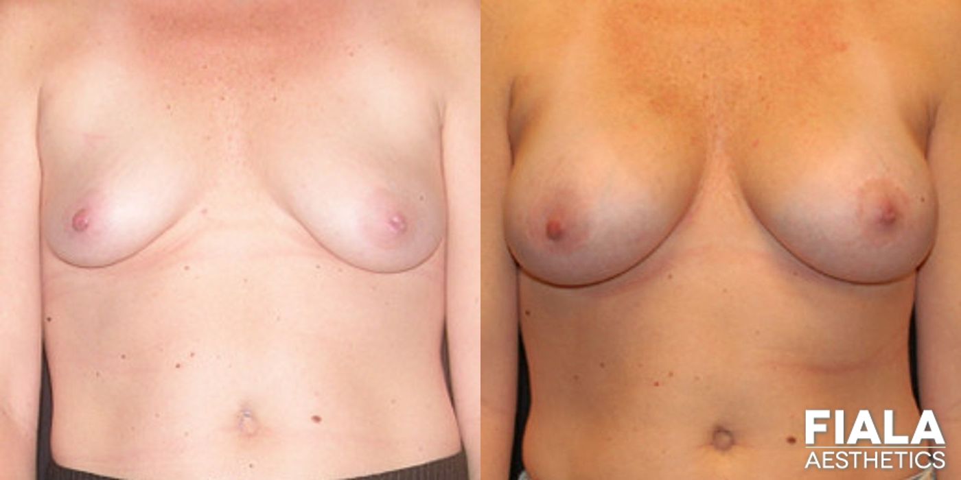 Before and after Breast Lift case 13738