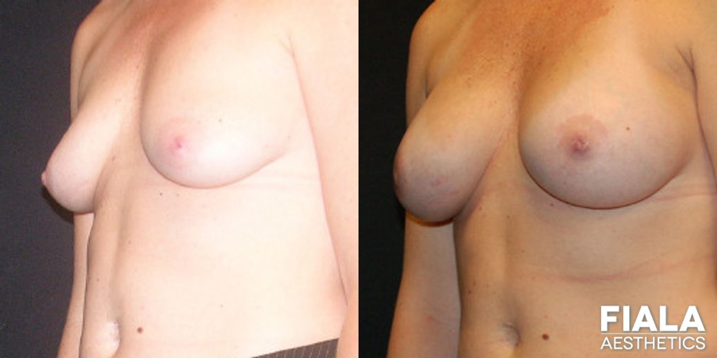 Before and after Breast Lift case 13738 - Angle 2