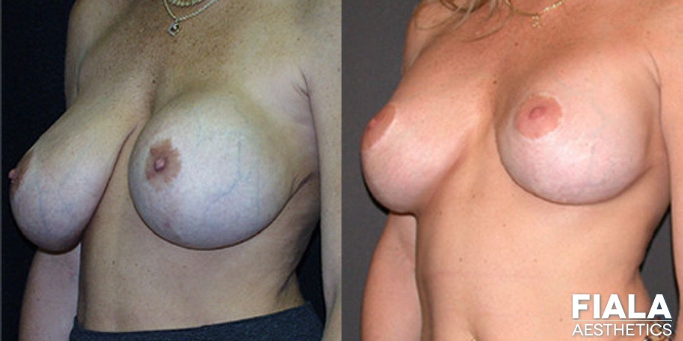 Breast Lift - Case 9171
