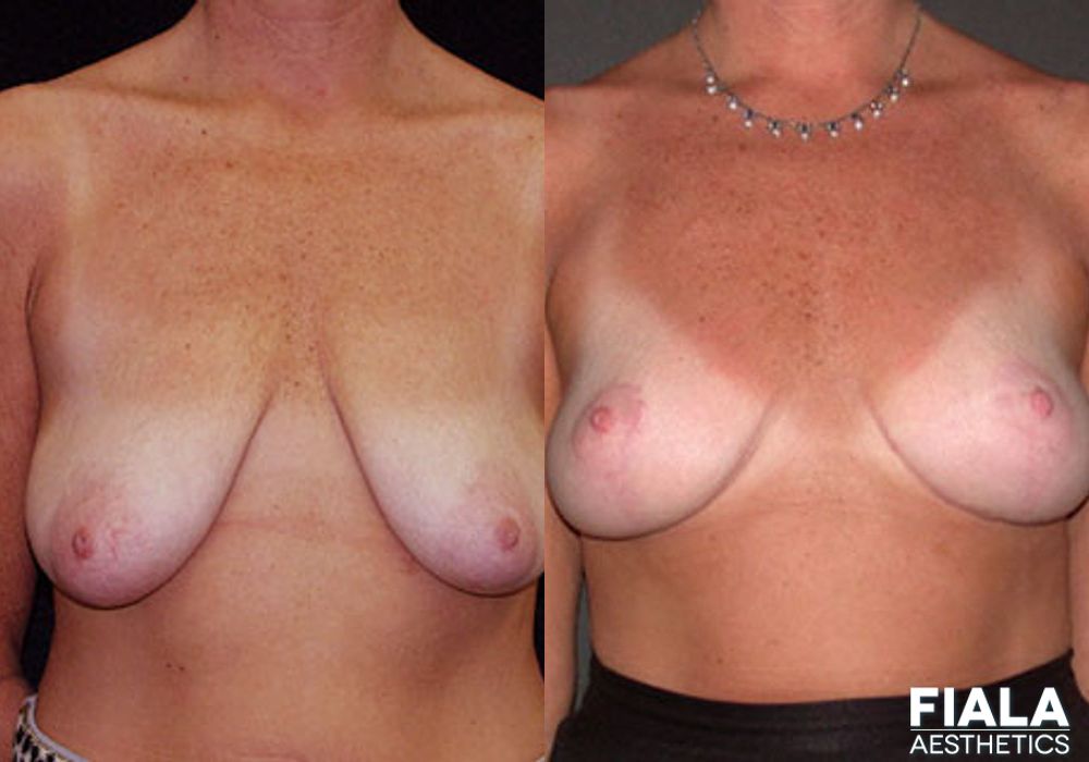 Breast Lift - Case 8958