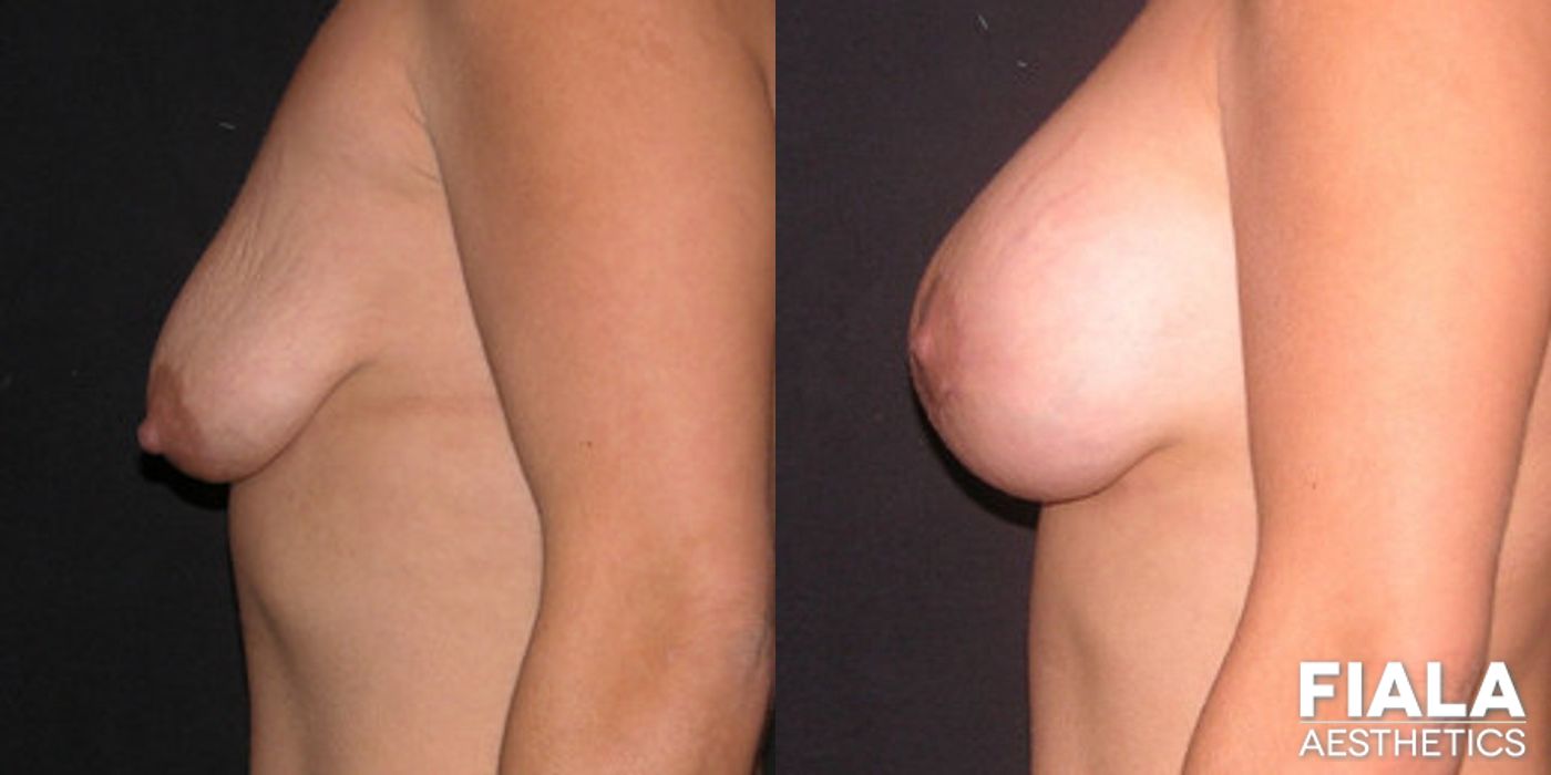 Before and after Breast Lift case 13737 - Angle 2