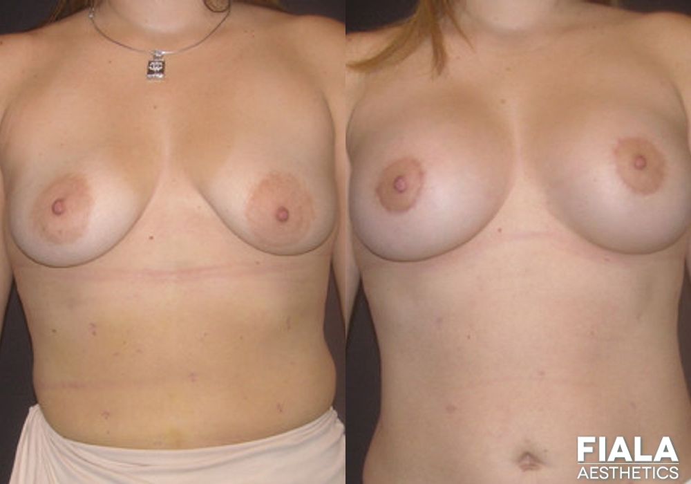 Breast Lift - Case 8946