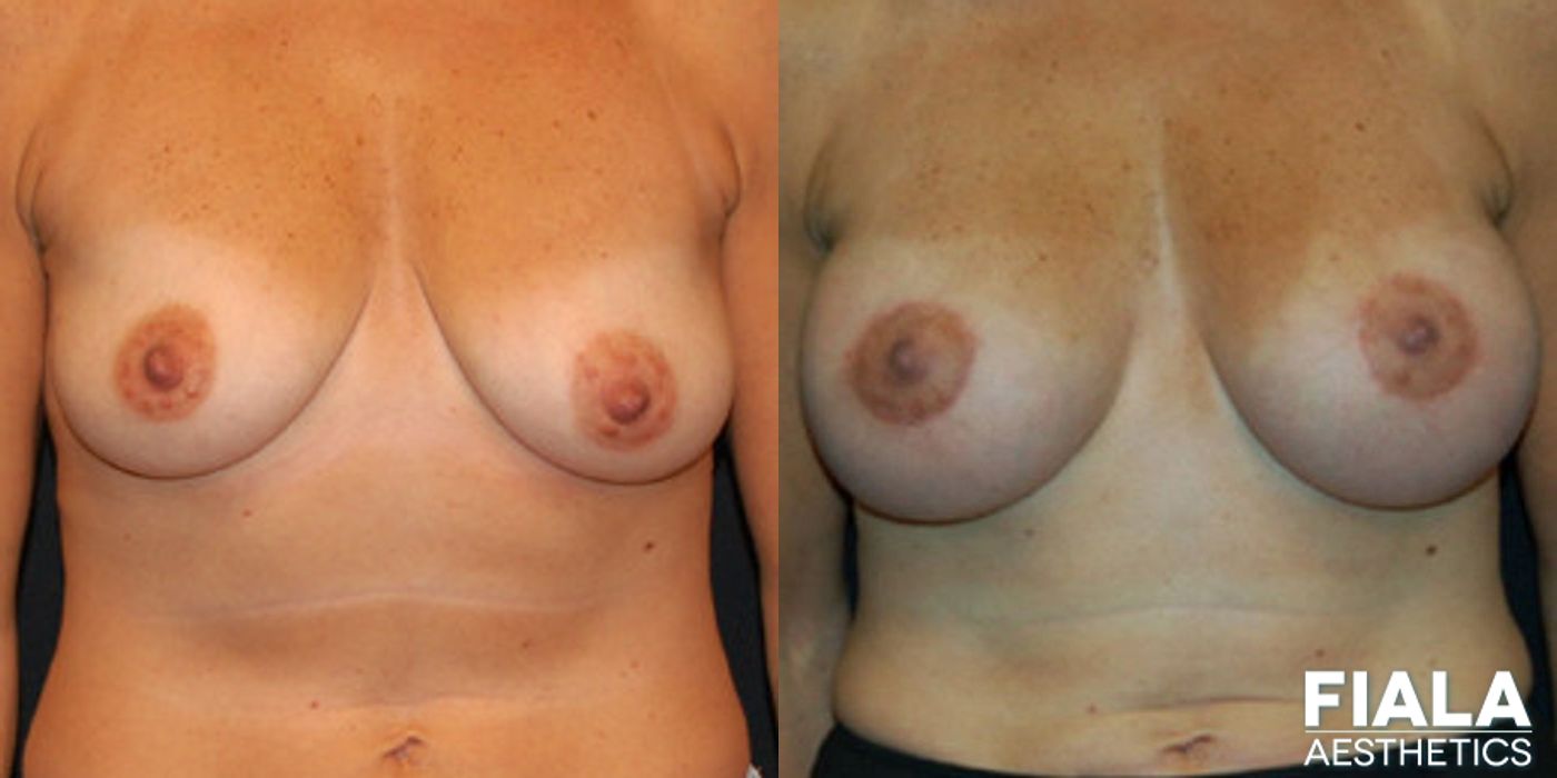 Breast Lift - Case 9160