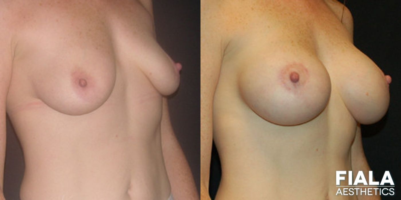 Before and after Breast Lift case 13739 - Angle 2