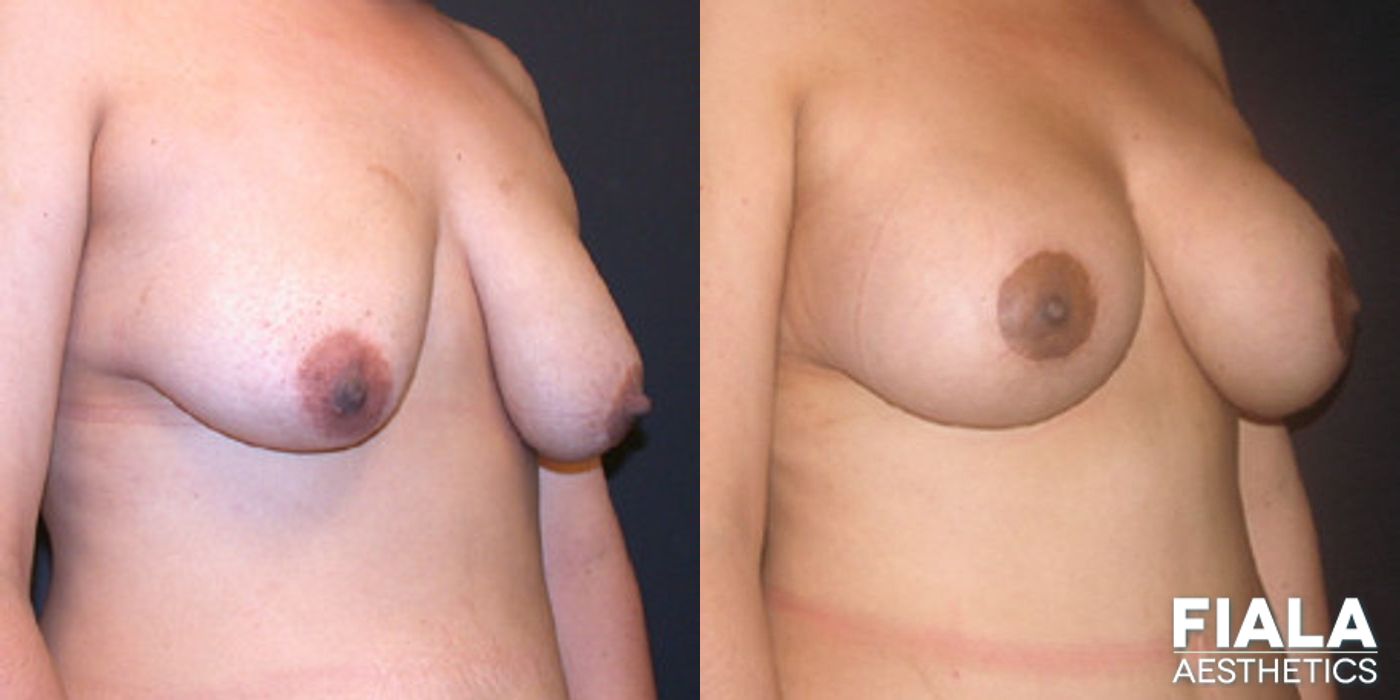 Before and after Breast Lift case 13751 - Angle 2