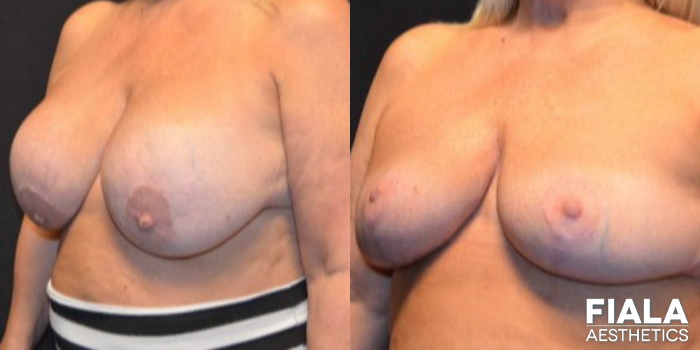 Before and after Breast Revision case 13730 - Angle 4