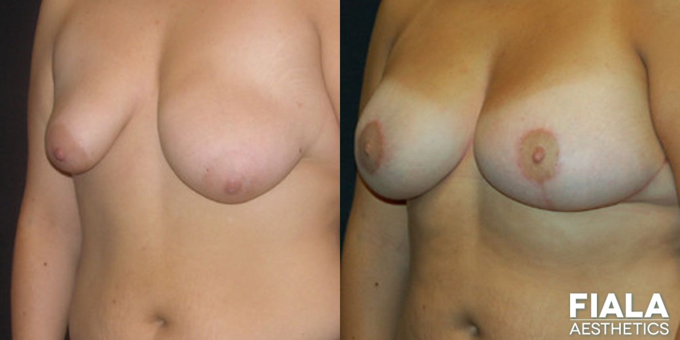 Breast Lift - Case 9182