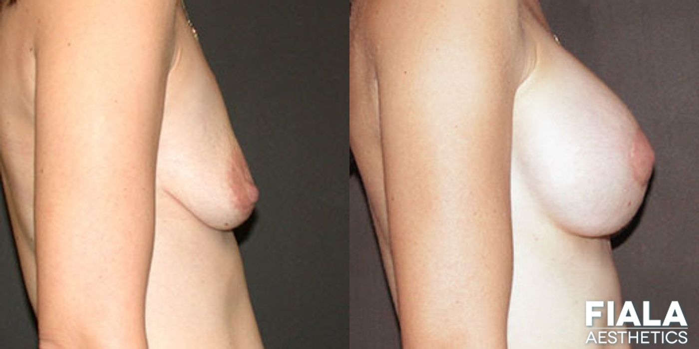 Breast Lift - Thumbnail 2