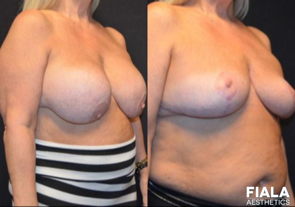 Breast Lift - Thumbnail 3