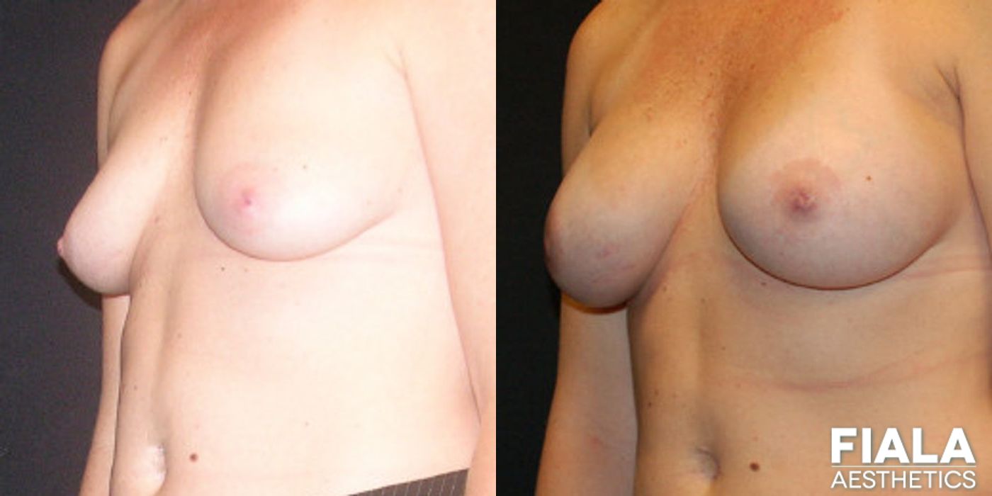 Breast Lift - Thumbnail 2