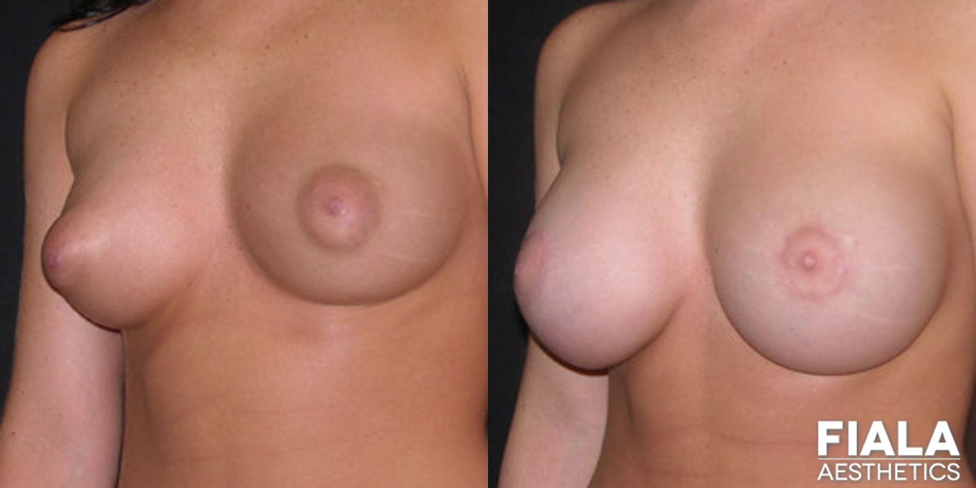 Breast Lift - Case 9159