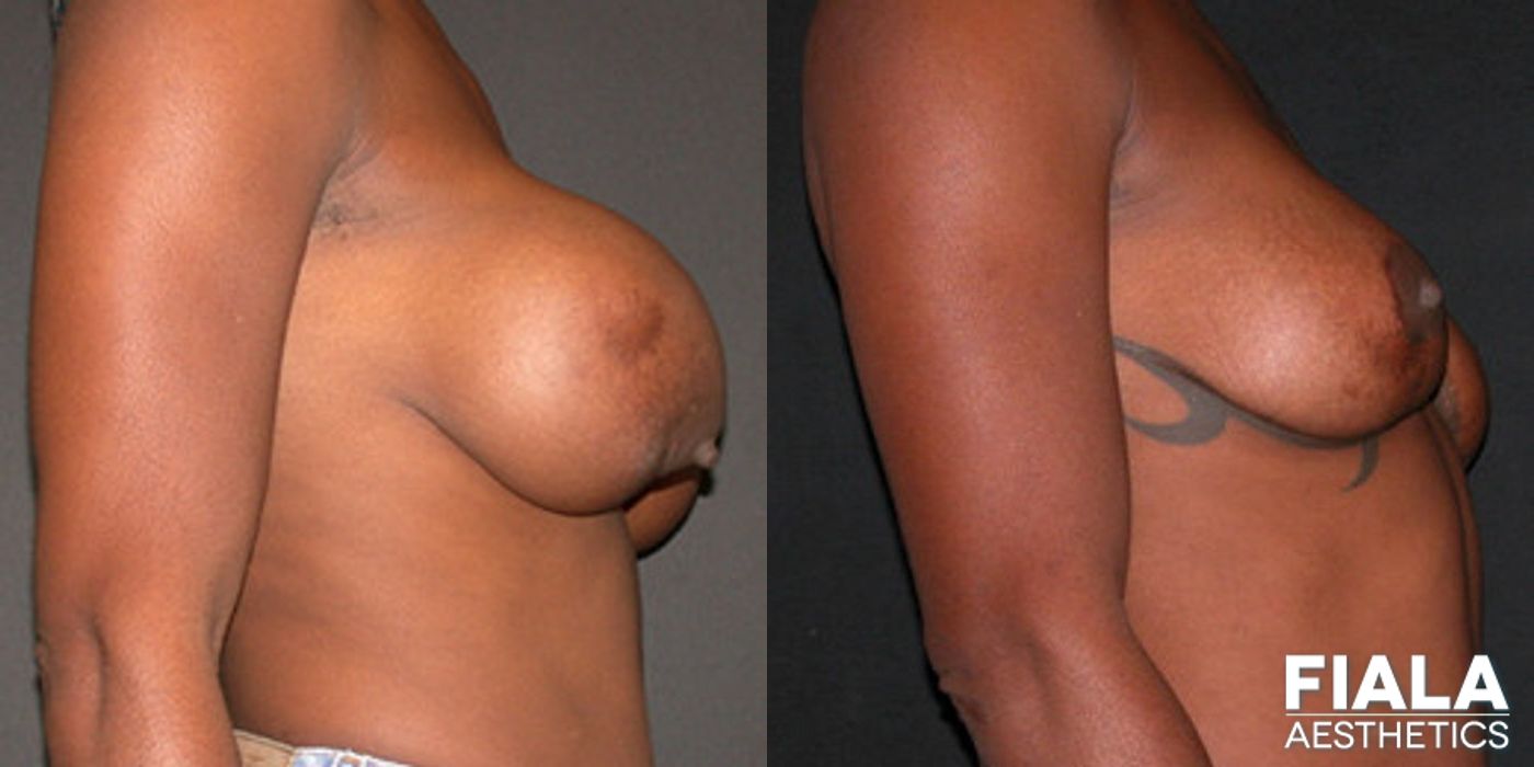 Before and after Breast Revision case 14002 - Angle 2