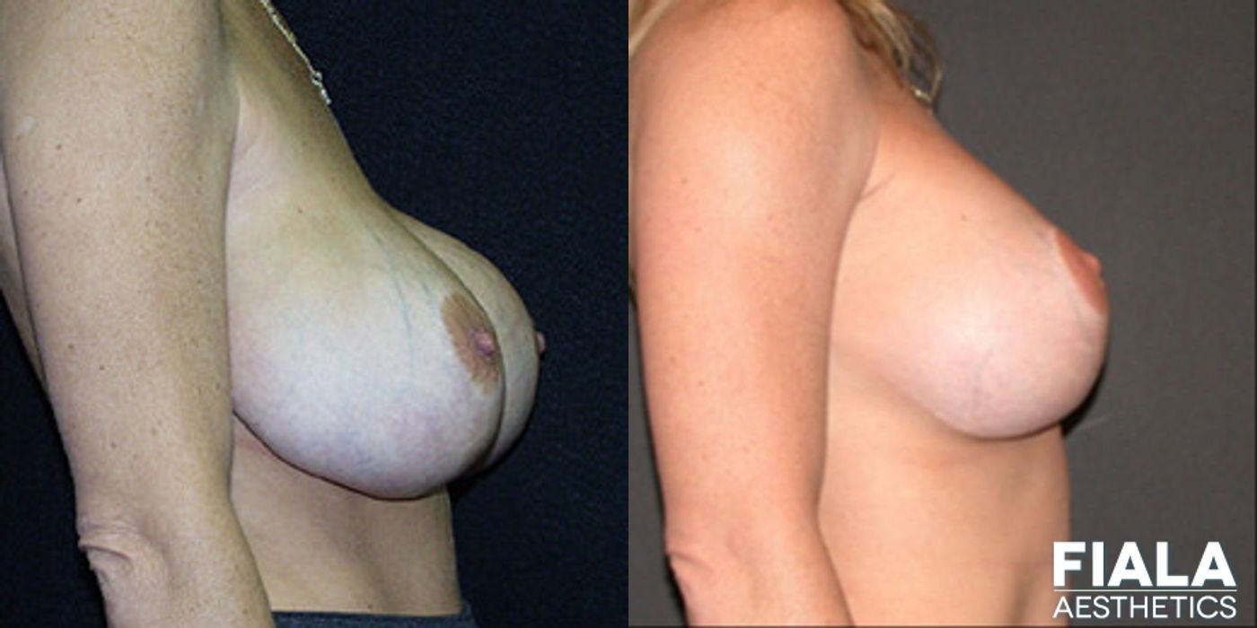 Breast Lift - Thumbnail 2