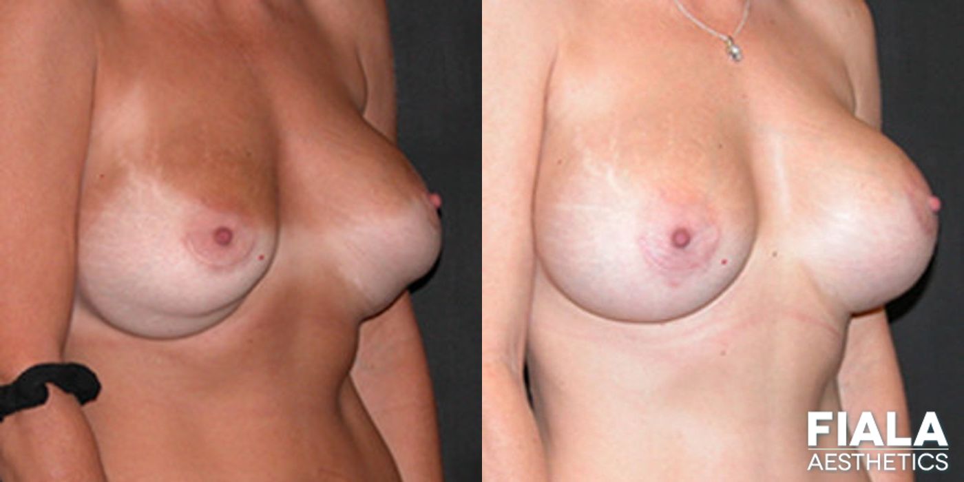 Before and after Breast Revision case 13746
