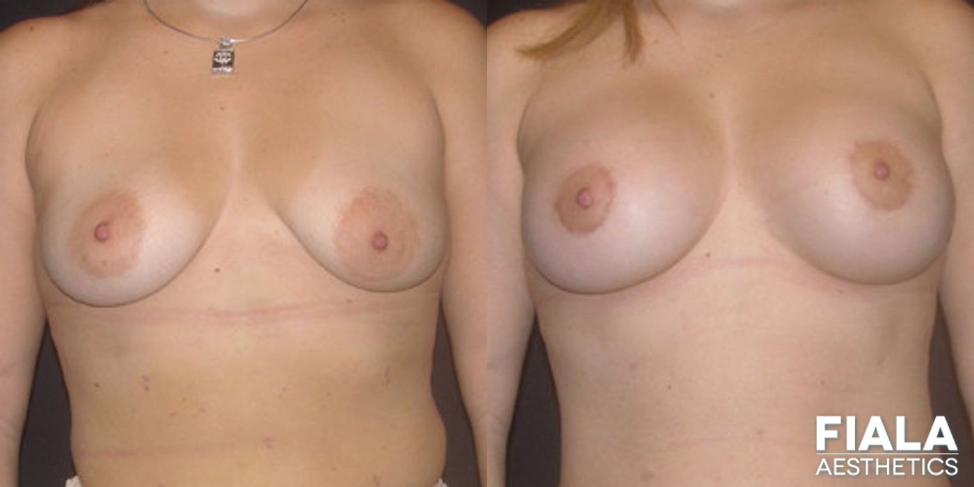Before and after Breast Lift case 13742