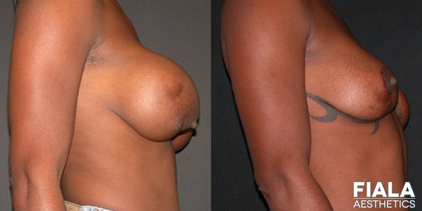 Implant Removal - Case 9219