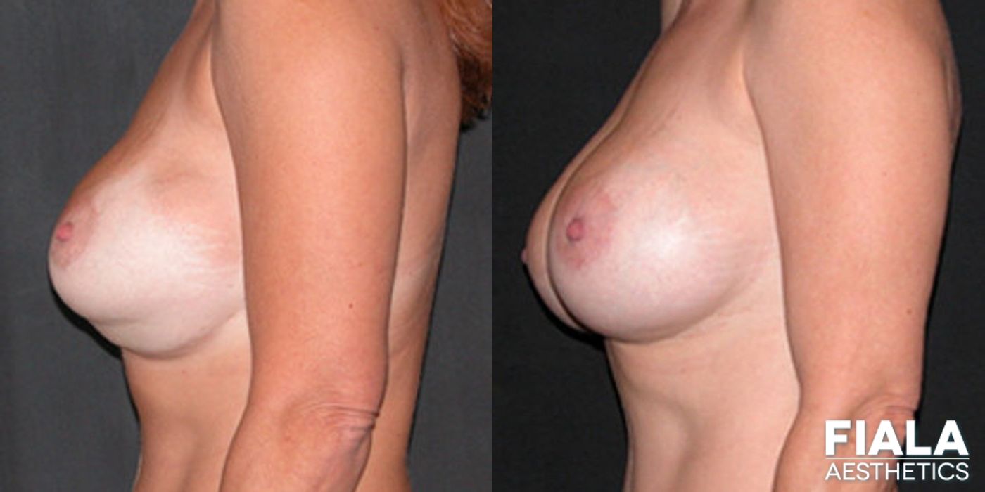 Before and after Breast Revision case 13746 - Angle 2