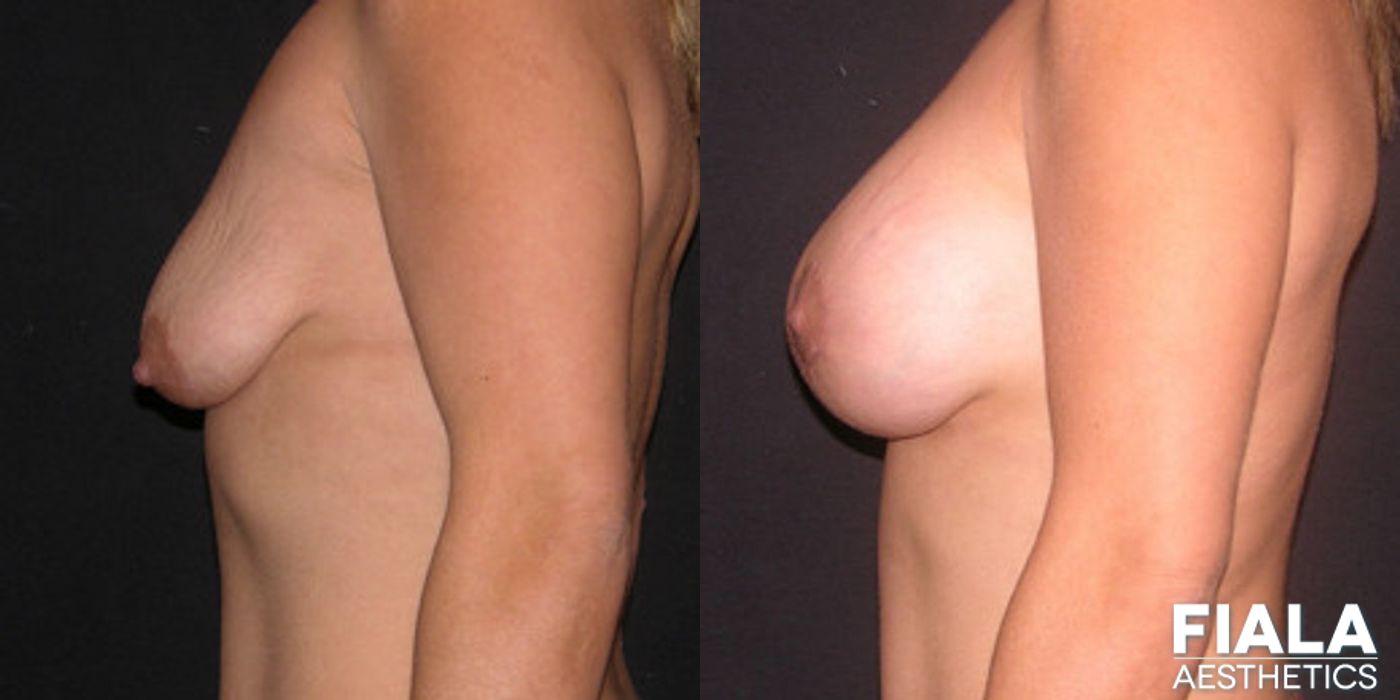 Breast Lift - Thumbnail 2