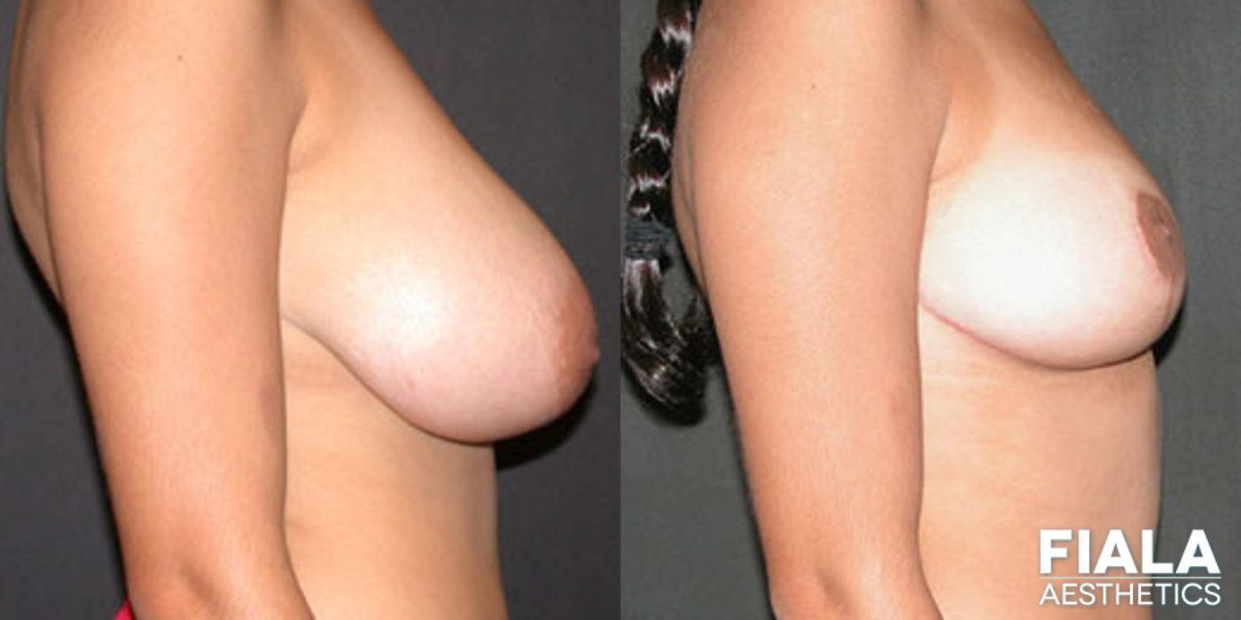 Before and after Breast Reduction case 13759 - Angle 2