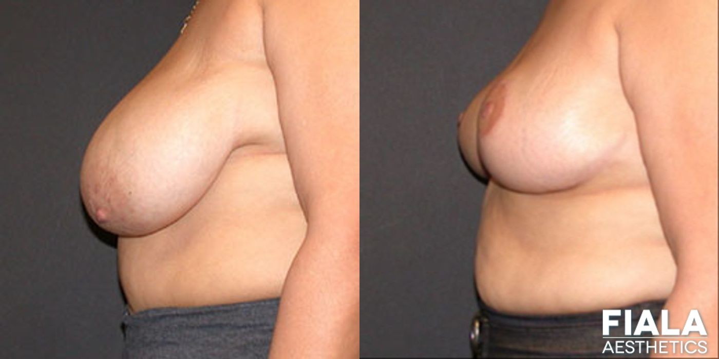Breast Reduction - Thumbnail 2