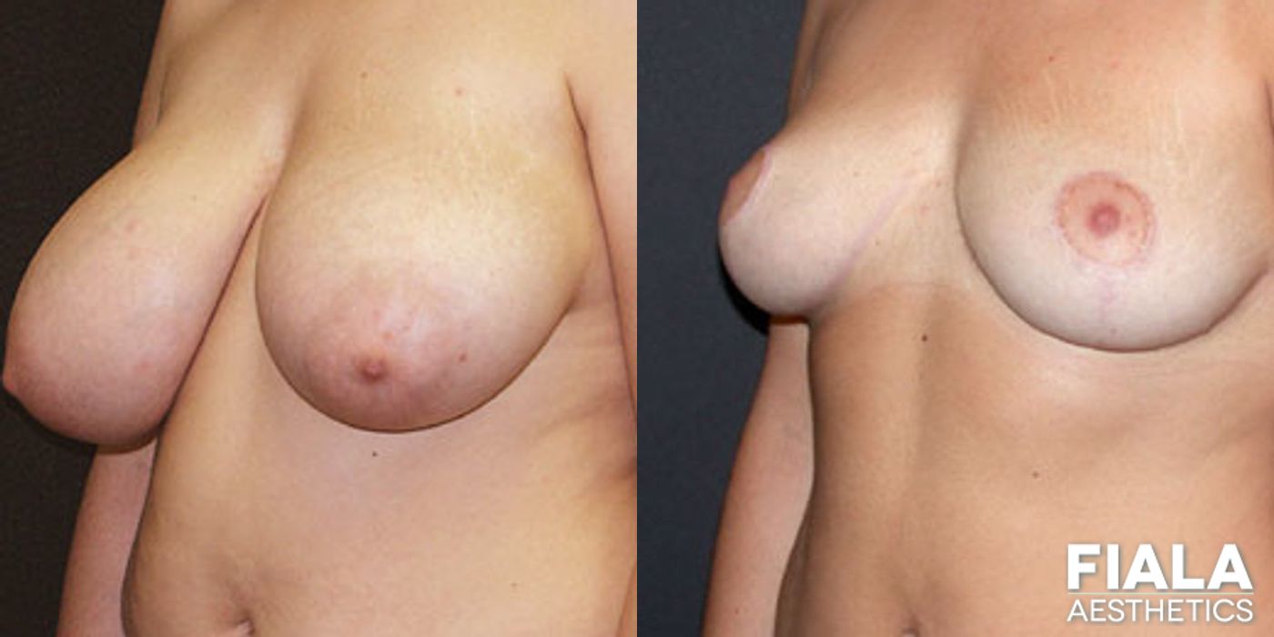 Before and after Breast Reduction case 13758 - Angle 2