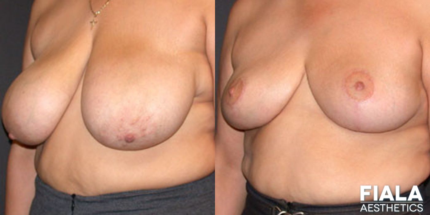 Breast Reduction - Case 9188