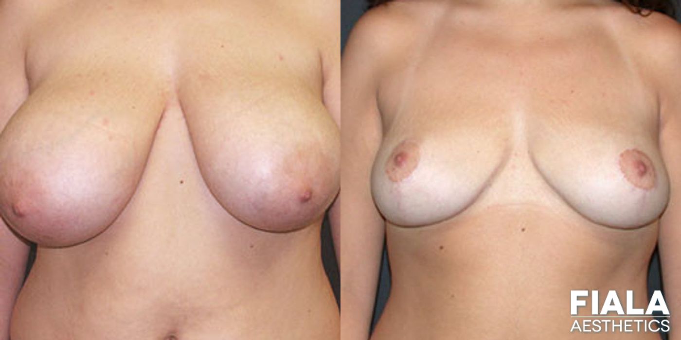 Before and after Breast Reduction case 13758