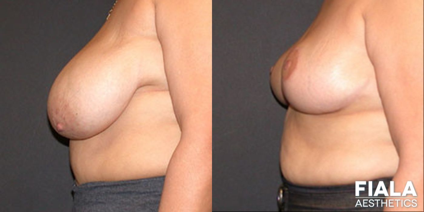 Before and after Breast Reduction case 13760 - Angle 2