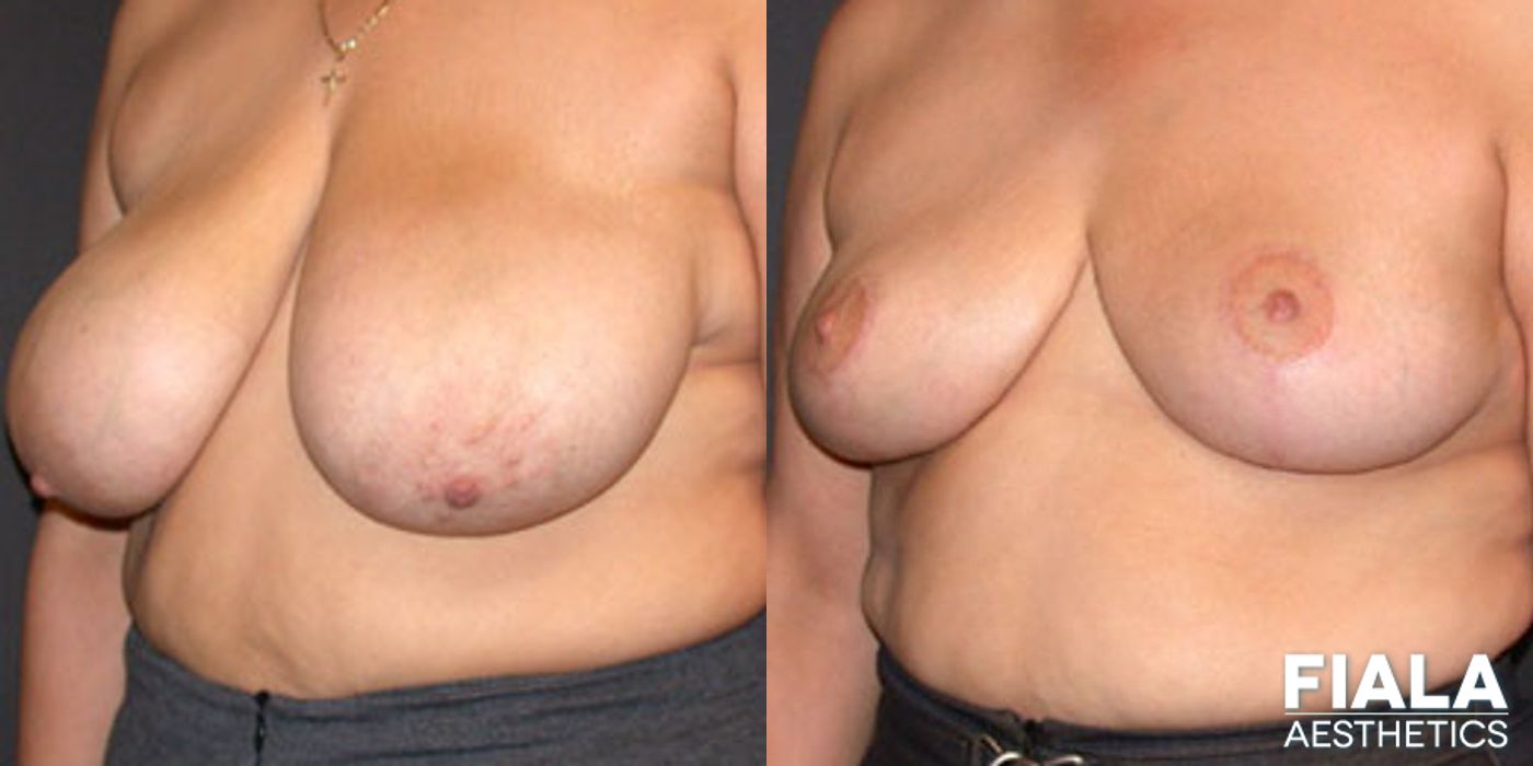 Before and after Breast Reduction case 13760