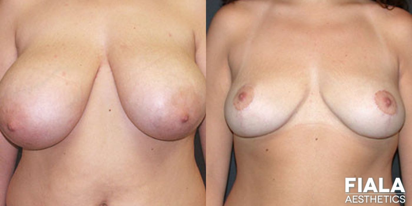 Breast Reduction - Case 9186