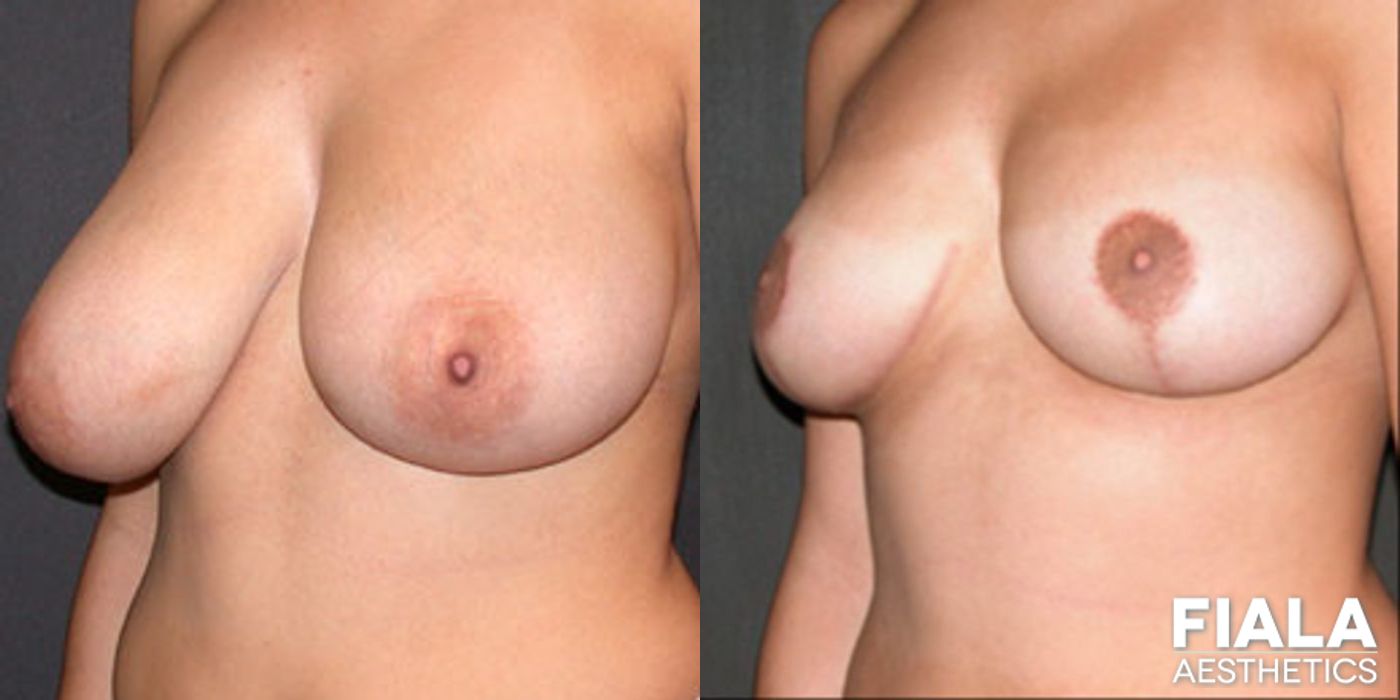 Before and after Breast Reduction case 13759