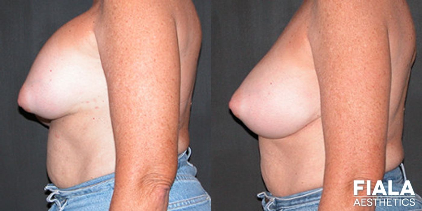 Before and after Breast Revision case 13762 - Angle 2