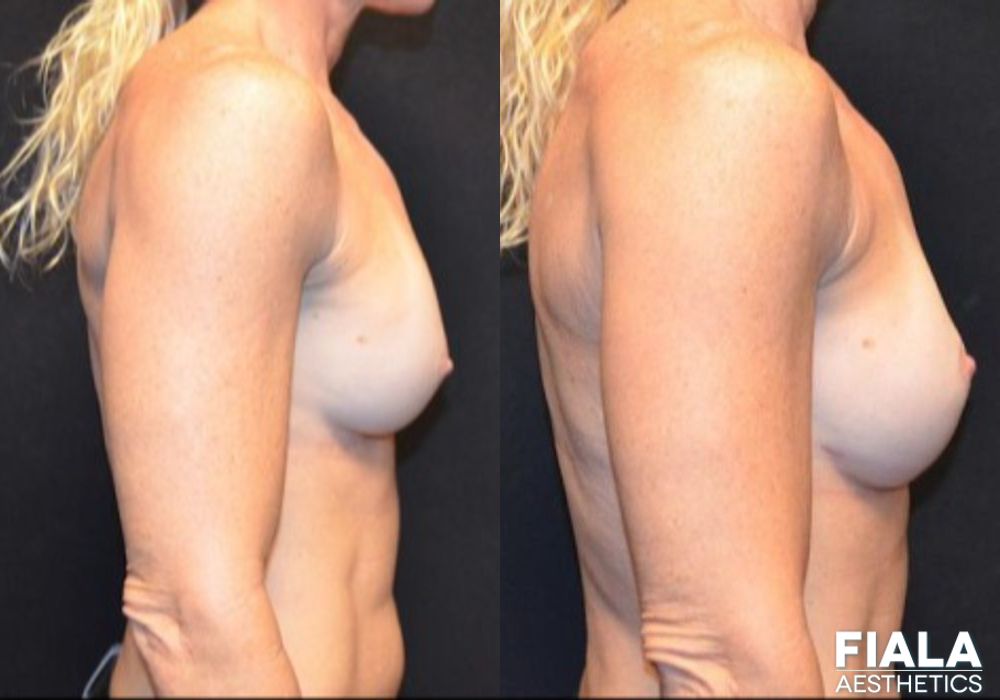 Breast Revision - Thumbnail 3