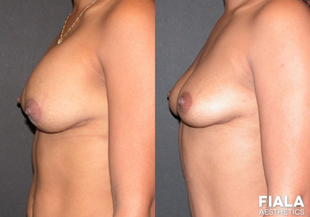 Breast Revision - Thumbnail 2