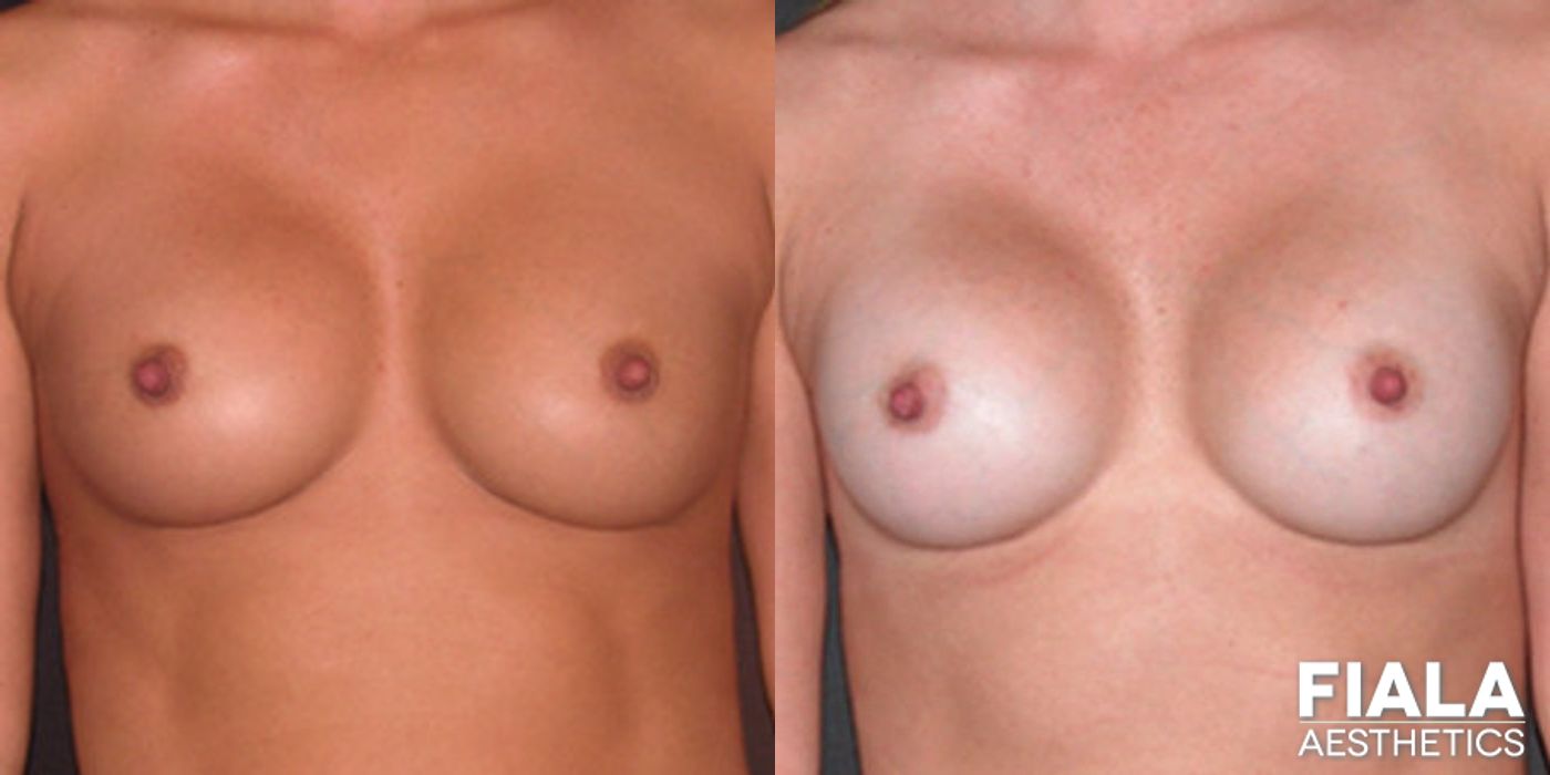 Before and after Breast Revision case 13787