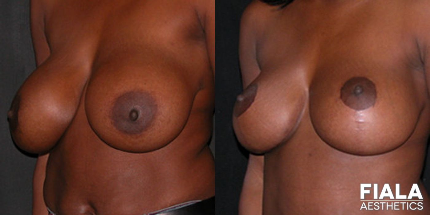 Before and after Breast Revision case 14009 - Angle 2