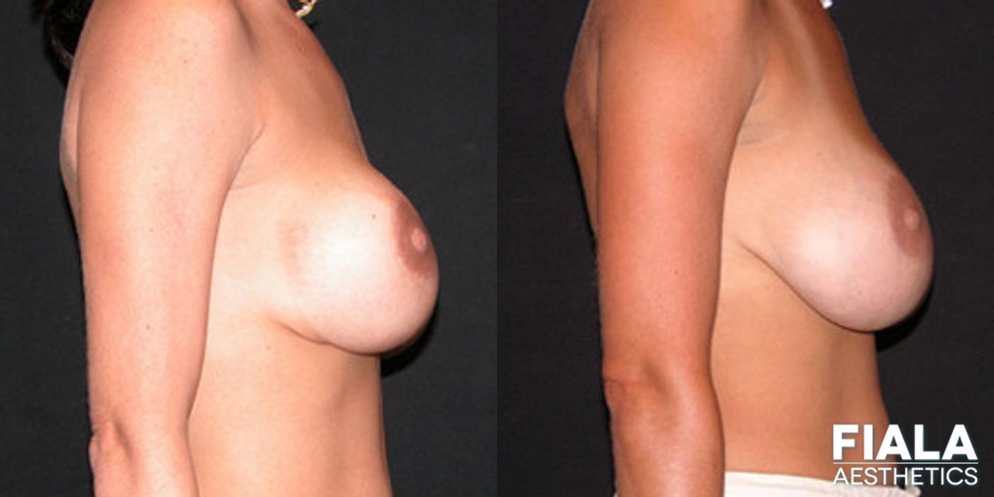 Before and after Breast Revision case 13768 - Angle 2