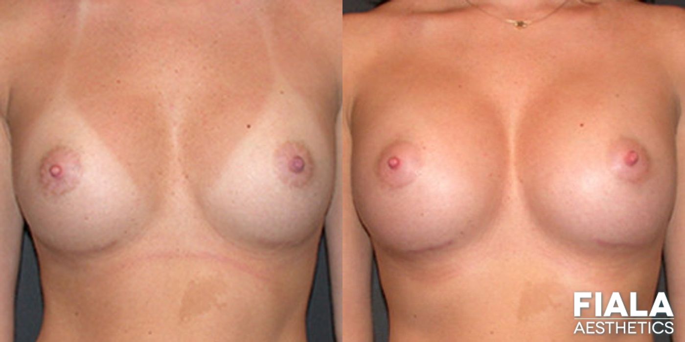 Before and after Breast Revision case 13788