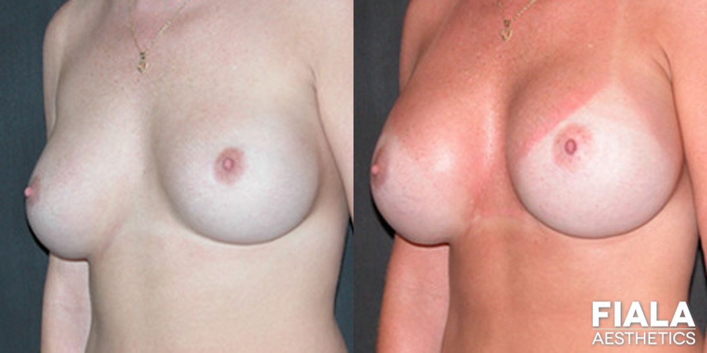 Before and after Breast Revision case 13790 - Angle 2