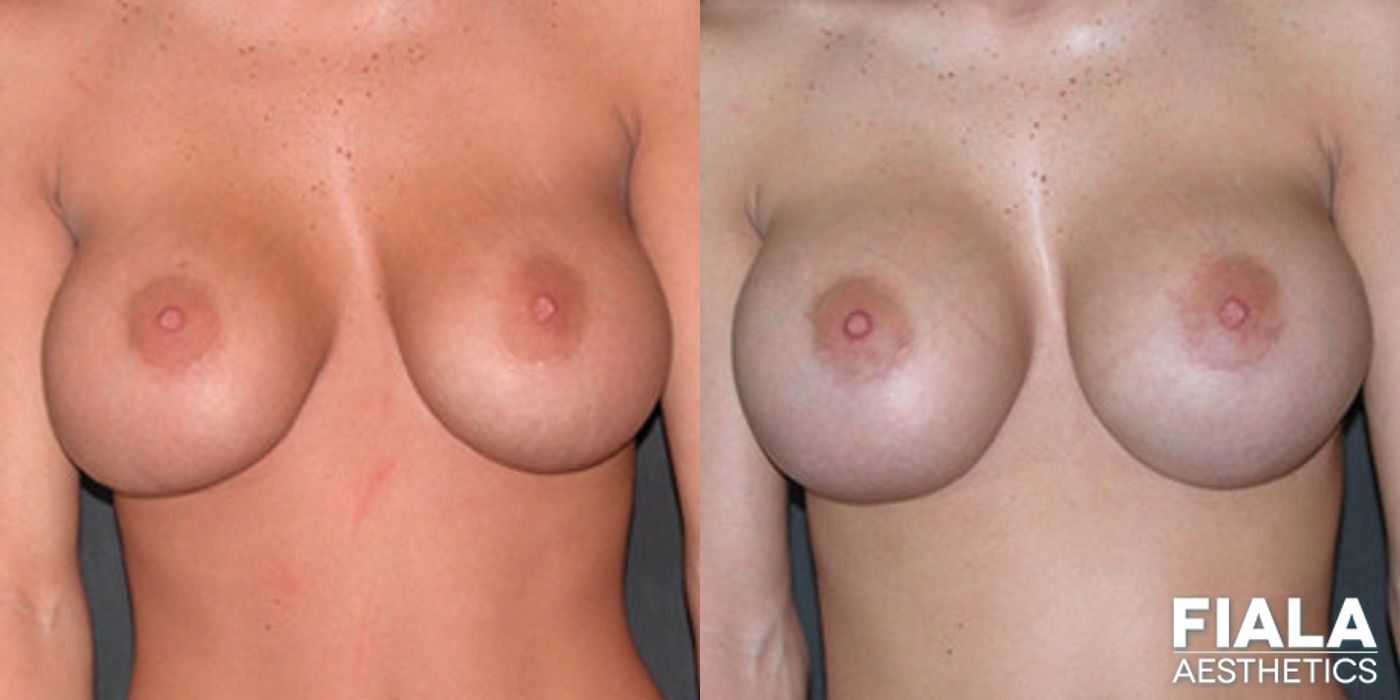 Before and after Breast Revision case 13776