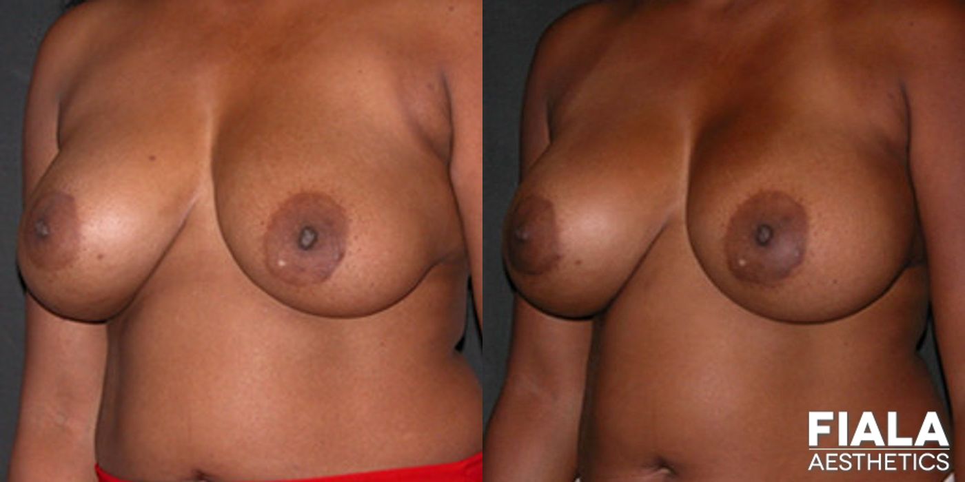 Before and after Breast Revision case 13763 - Angle 2