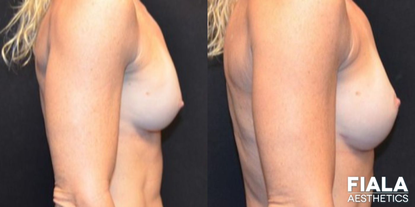 Before and after Breast Revision case 14005 - Angle 3
