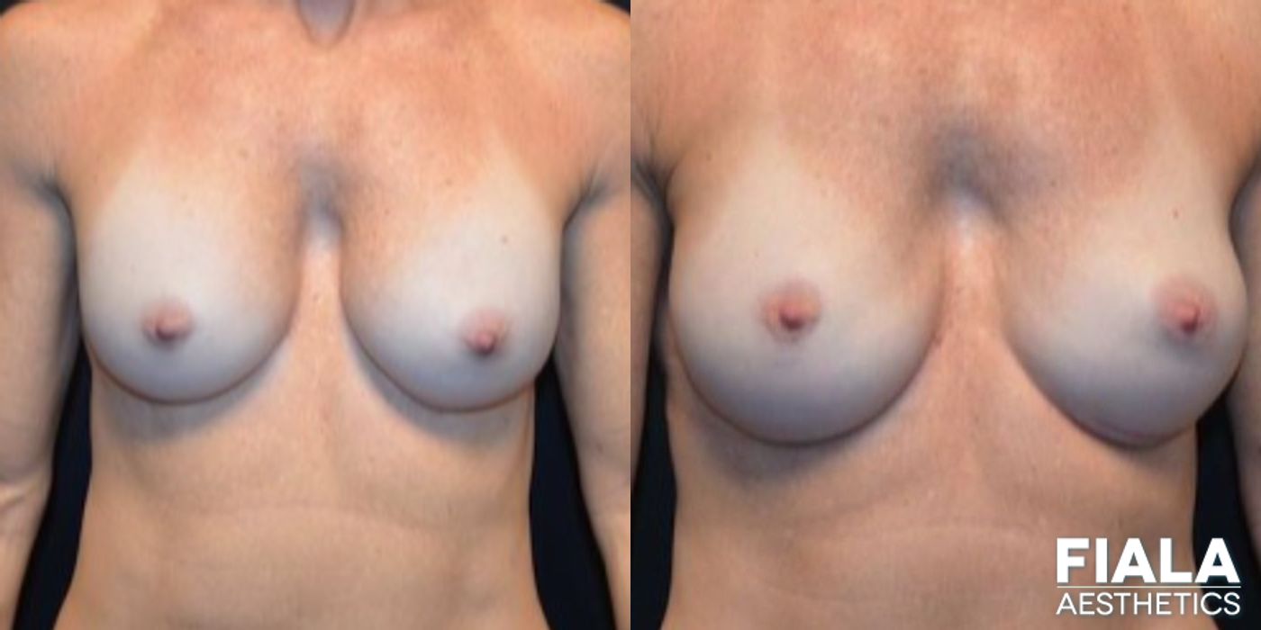 Before and after Breast Revision case 14005