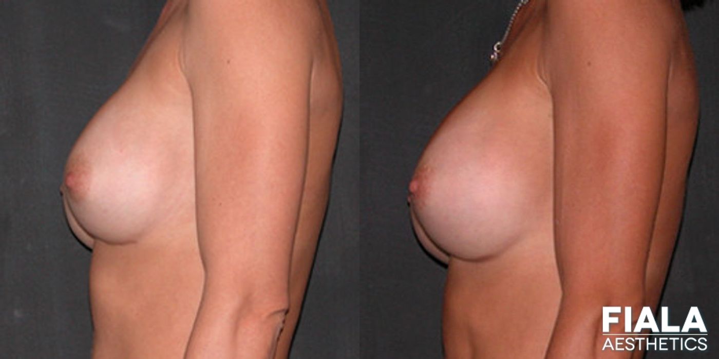 Before and after Breast Revision case 13786 - Angle 2
