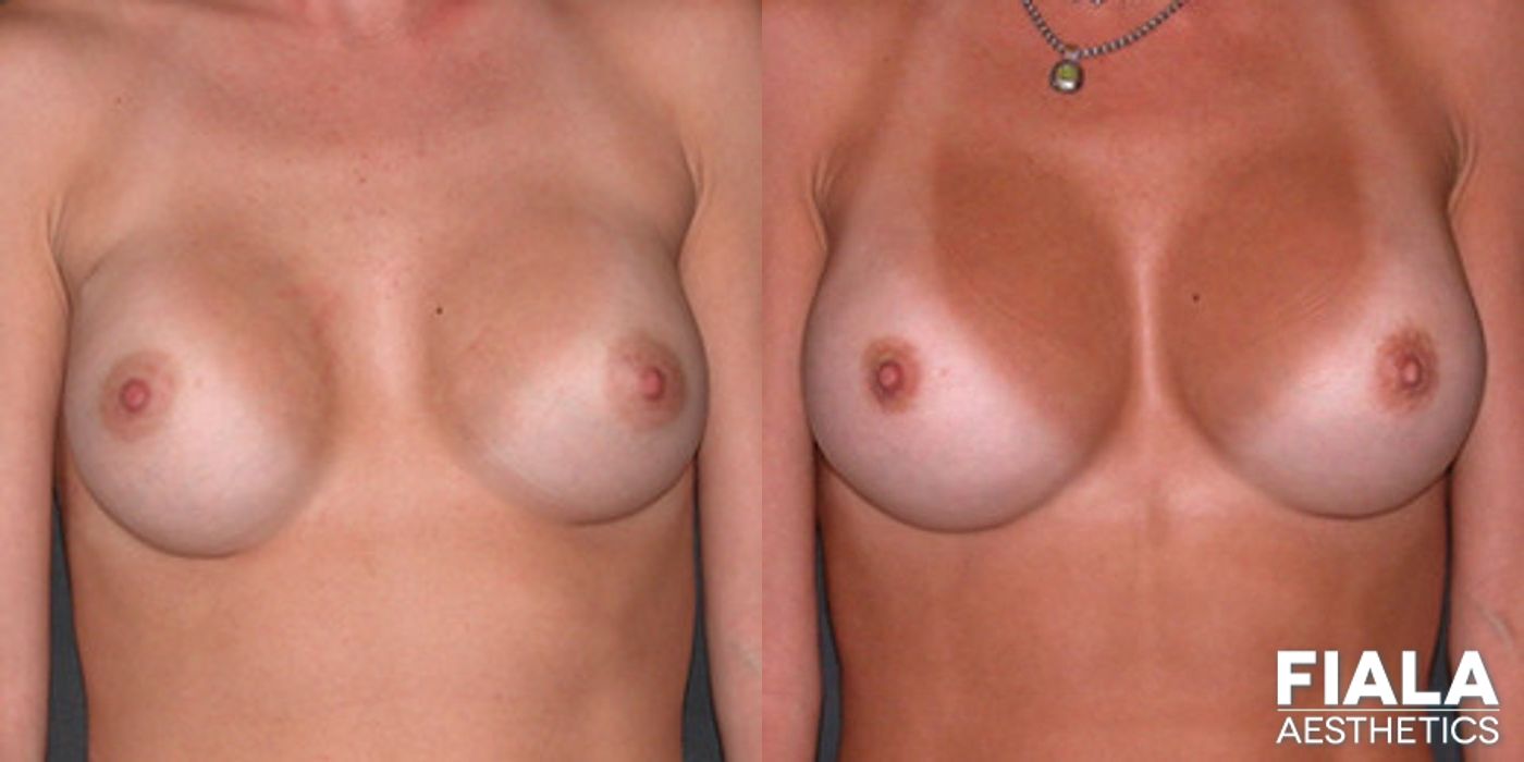 Before and after Breast Revision case 13786
